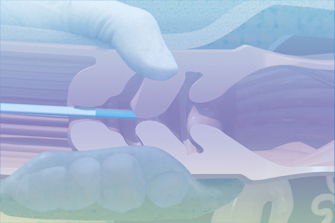 Техника искусственного осеменения